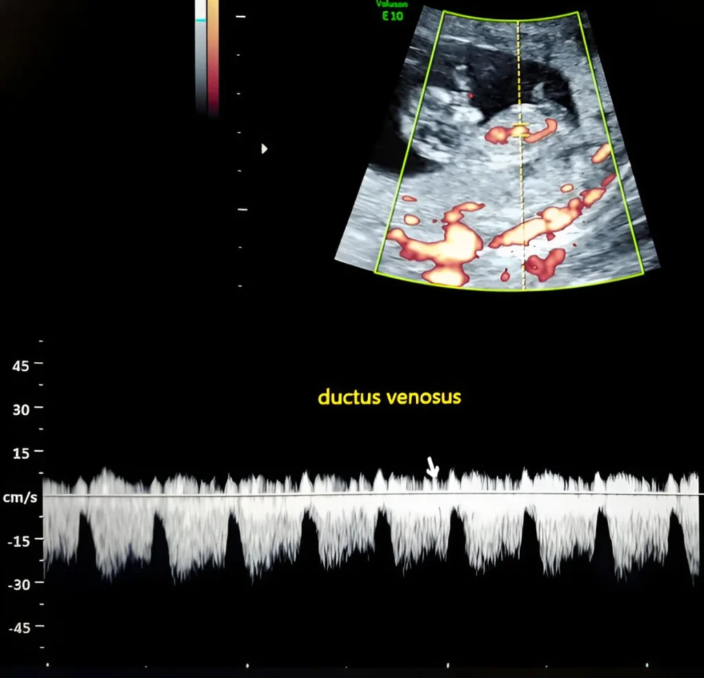 ductus-venous-doppler-obstetrics-(OBS)-doppler-in-kharghar-advanced-diagnostic-centre-best-diagnostic-centre-henotic-diagnostics-kharghar-navi-mumbai