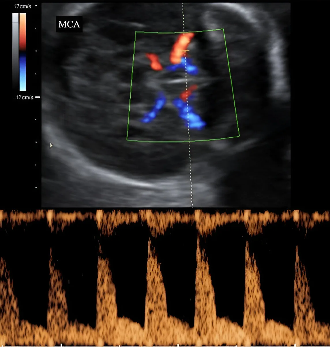 mca-doppler-obstetrics-(OBS)-doppler-in-kharghar-advanced-diagnostic-centre-best-diagnostic-centre-henotic-diagnostics-kharghar-navi-mumbai