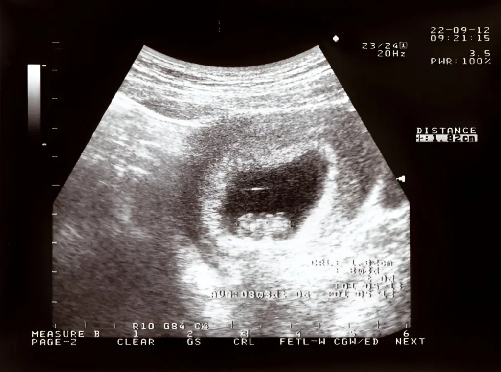 placental-doppler-mapping-obstetrics-(OBS)-doppler-in-kharghar-advanced-diagnostic-centre-best-diagnostic-centre-henotic-diagnostics-kharghar-navi-mumbai